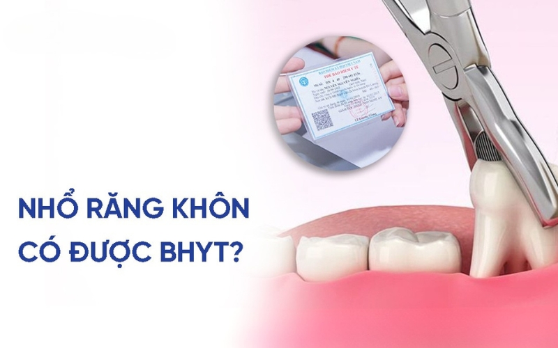 Nhổ răng khôn có được bảo hiểm chi trả không