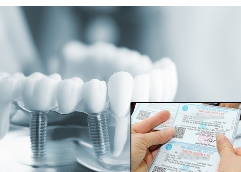 Nhổ răng khôn có thể được bảo hiểm chi trả