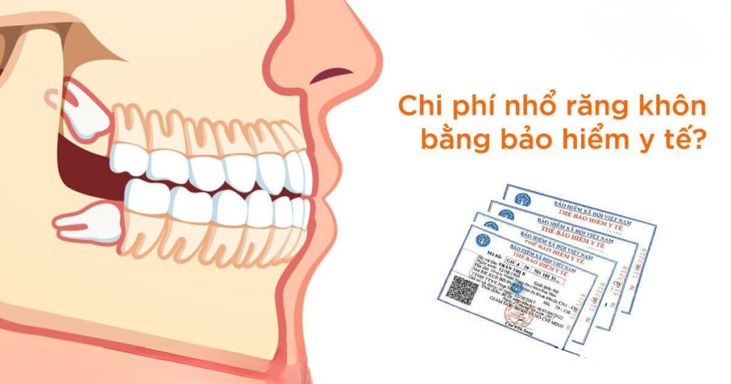 Chi phí nhổ răng khôn có bảo hiểm y tế
