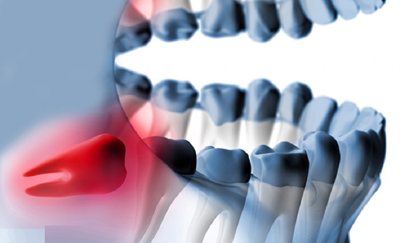 Răng khôn gây ảnh hưởng tới sức khoẻ